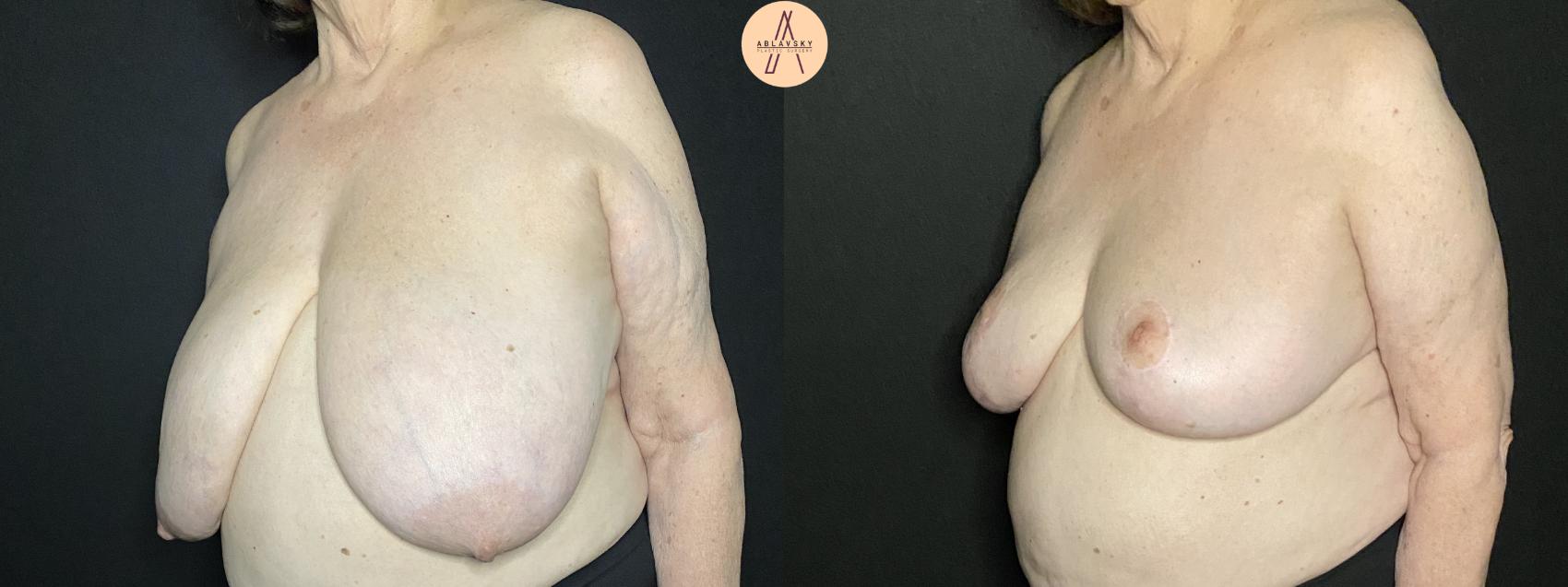 Before & After Breast Lift Case 98 Left Oblique View in San Antonio, Texas