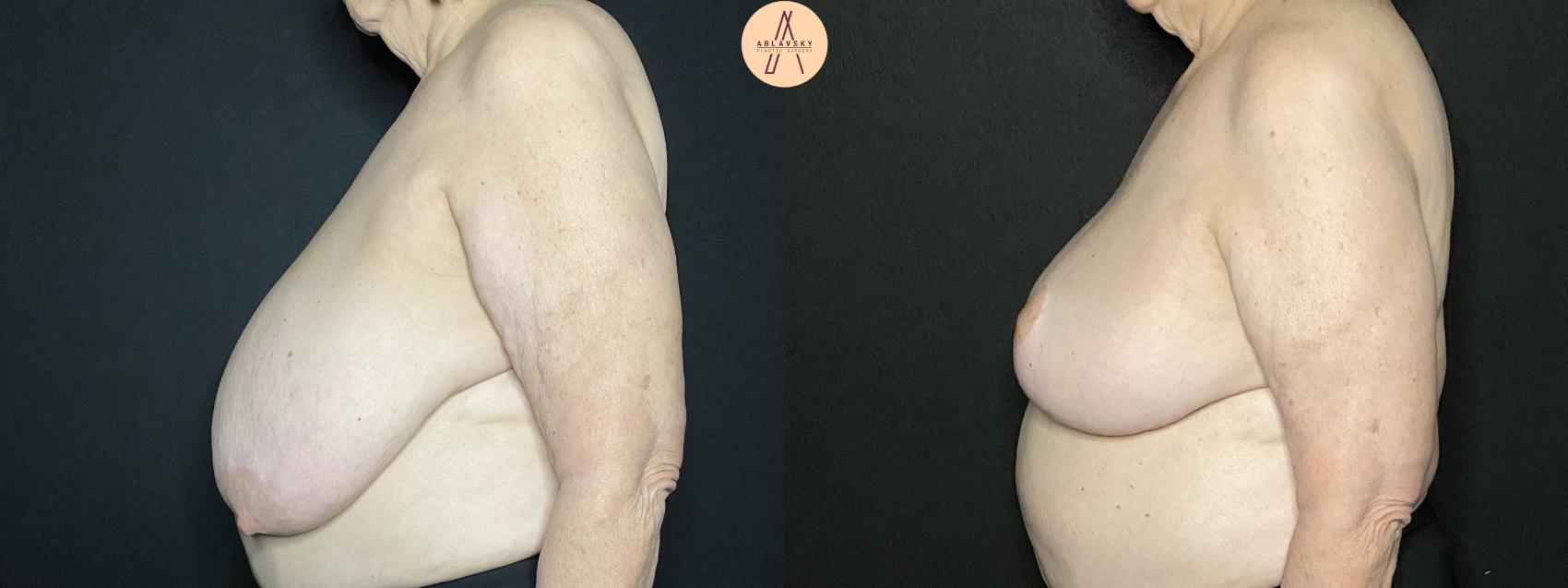 Before & After Breast Lift Case 98 Left Side View in San Antonio, Texas