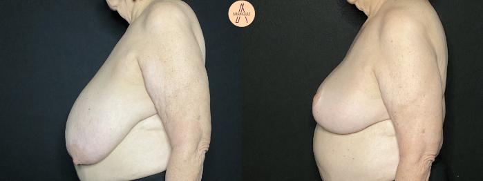 Before & After Breast Reduction Case 98 Left Side View in San Antonio, Texas