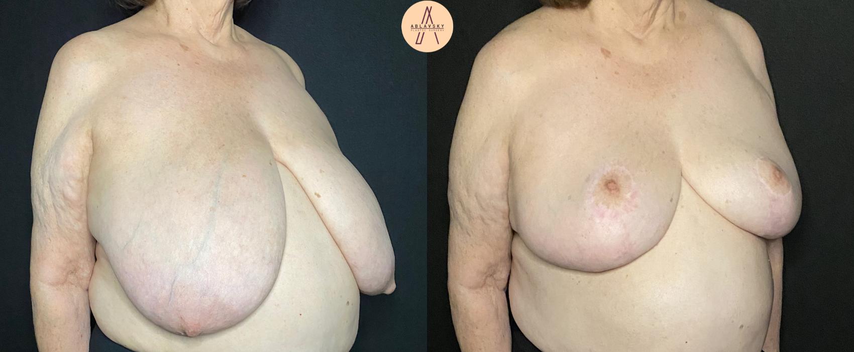 Before & After Breast Lift Case 98 Right Oblique View in San Antonio, Texas