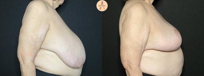 Before & After Breast Reduction Case 98 Right Side View in San Antonio, Texas