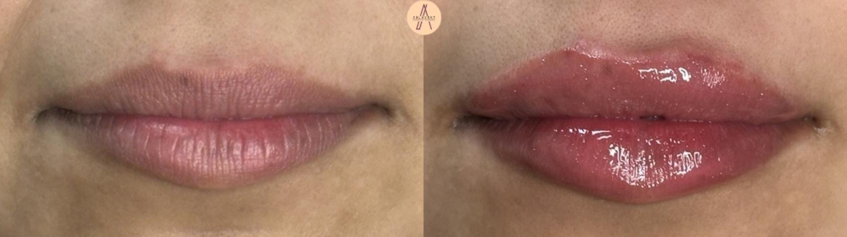 Before & After Dermal Fillers Case 409 Relaxed  View in San Antonio, Texas