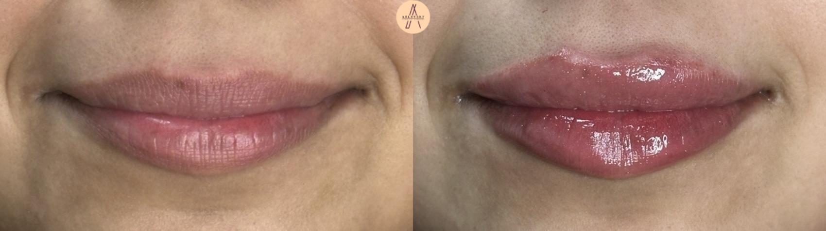 Before & After Dermal Fillers Case 409 Soft Smile View in San Antonio, Texas