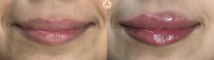 Before & After Dermal Fillers Case 409 Soft Smile View in San Antonio, Texas
