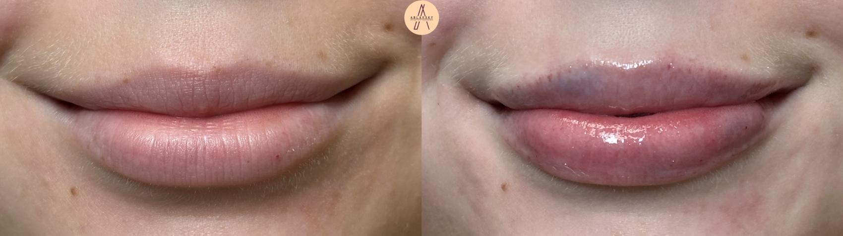 Before & After Dermal Fillers Case 410 Front View in San Antonio, Texas