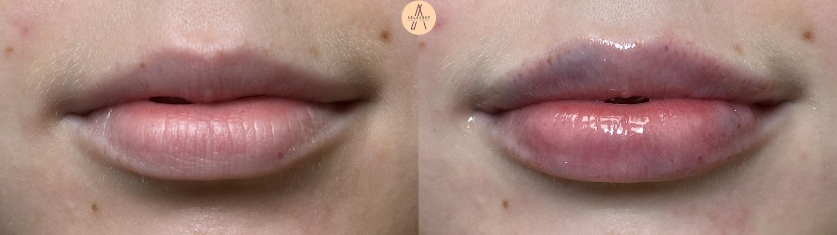 Before & After Dermal Fillers Case 410 Relaxed  View in San Antonio, Texas