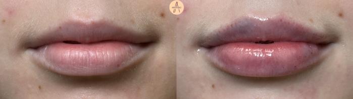 Before & After Dermal Fillers Case 410 Relaxed  View in San Antonio, Texas