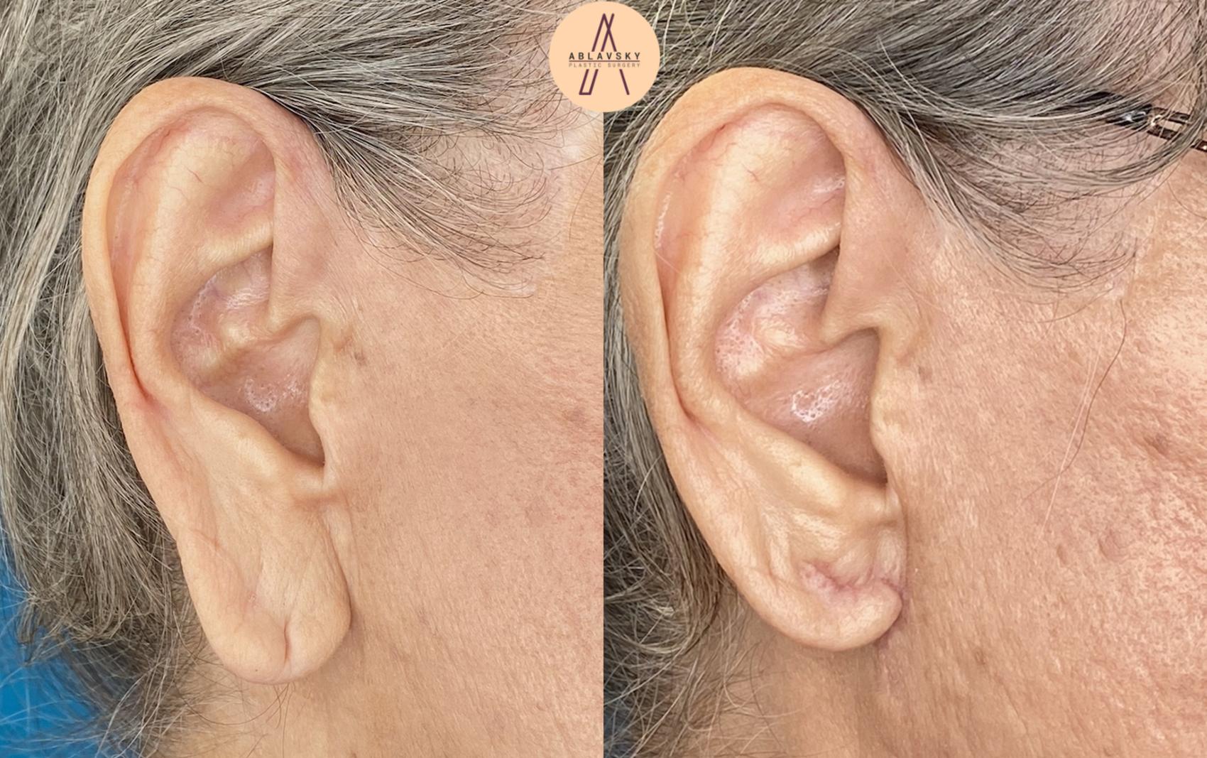 Before & After Ear Surgery Case 19 Right Side View in San Antonio, Texas