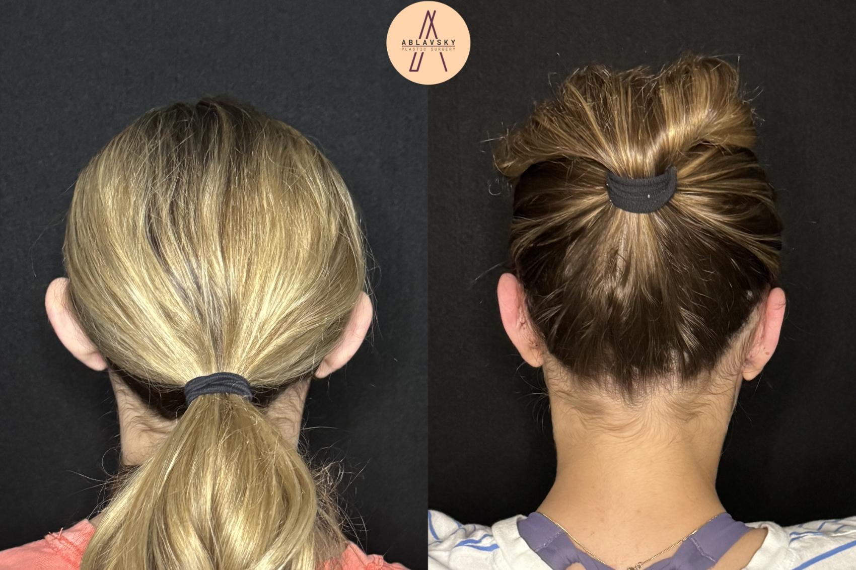 Before & After Ear Surgery Case 478 Back View in San Antonio, Texas