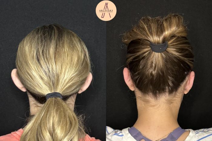 Before & After Ear Surgery Case 478 Back View in San Antonio, Texas
