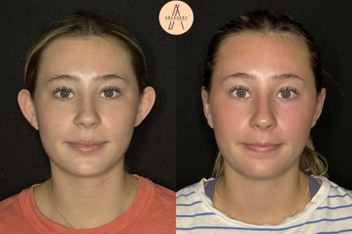 Before & After Ear Surgery Case 478 Front View in San Antonio, Texas
