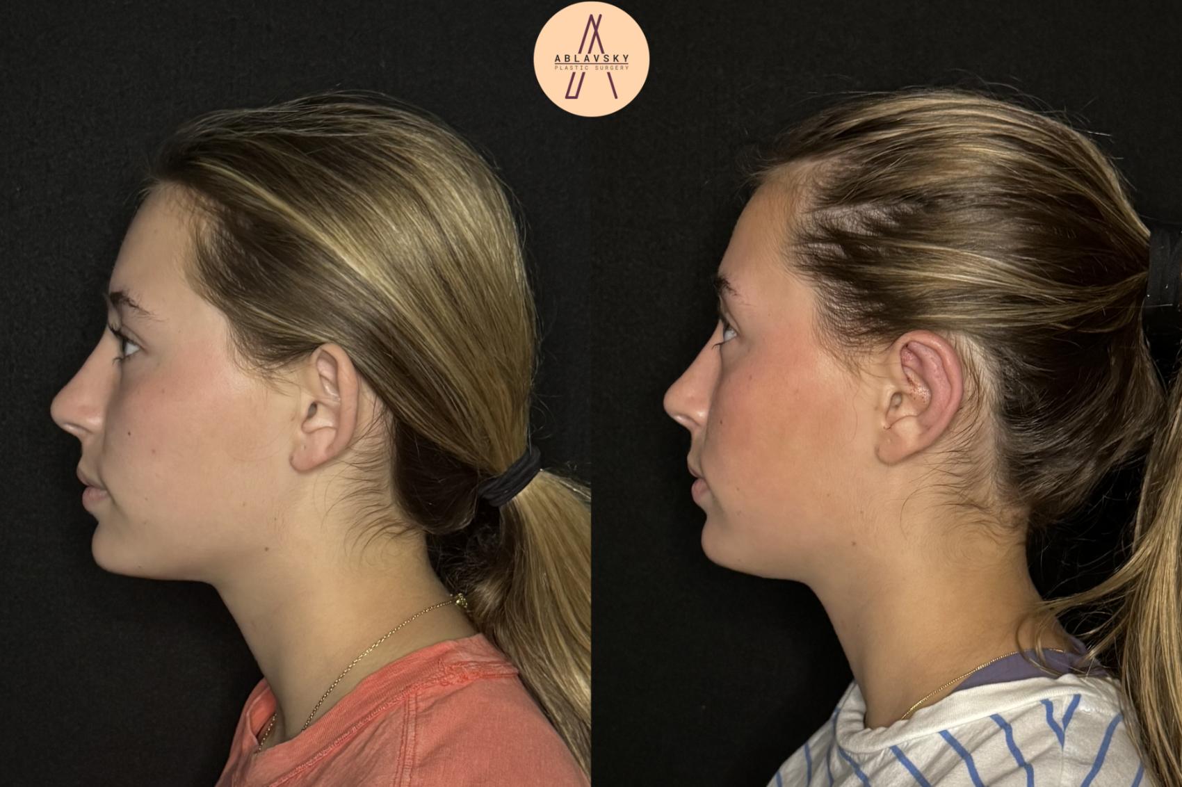Before & After Ear Surgery Case 478 Left Side View in San Antonio, Texas