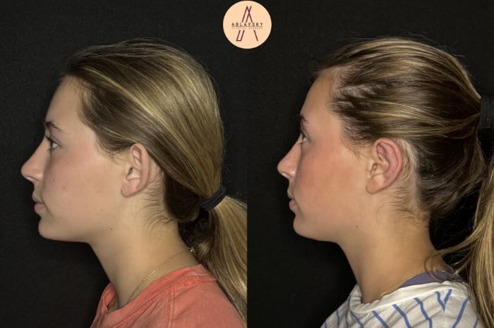 Before & After Ear Surgery Case 478 Left Side View in San Antonio, Texas