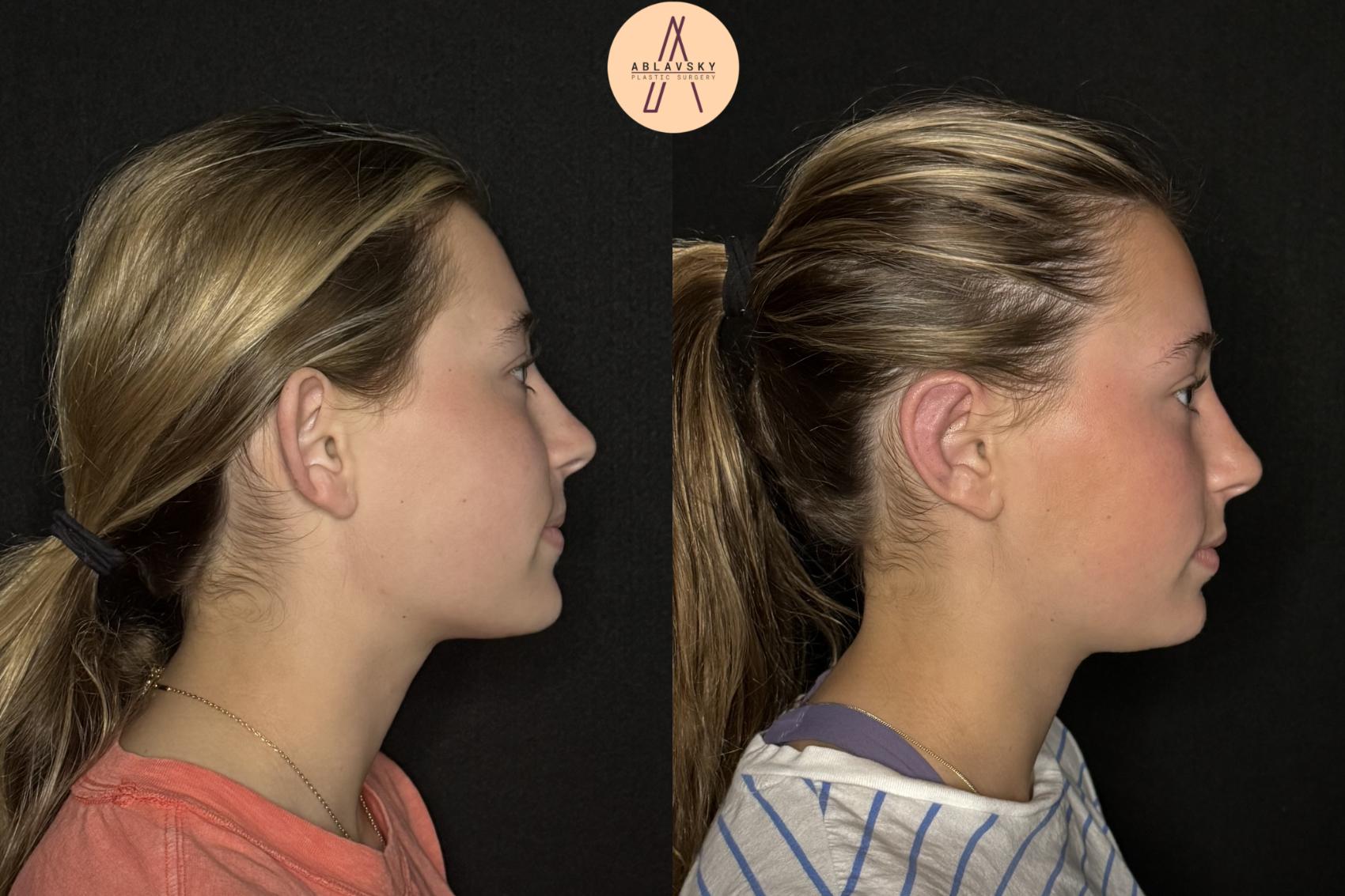 Before & After Ear Surgery Case 478 Right Side View in San Antonio, Texas