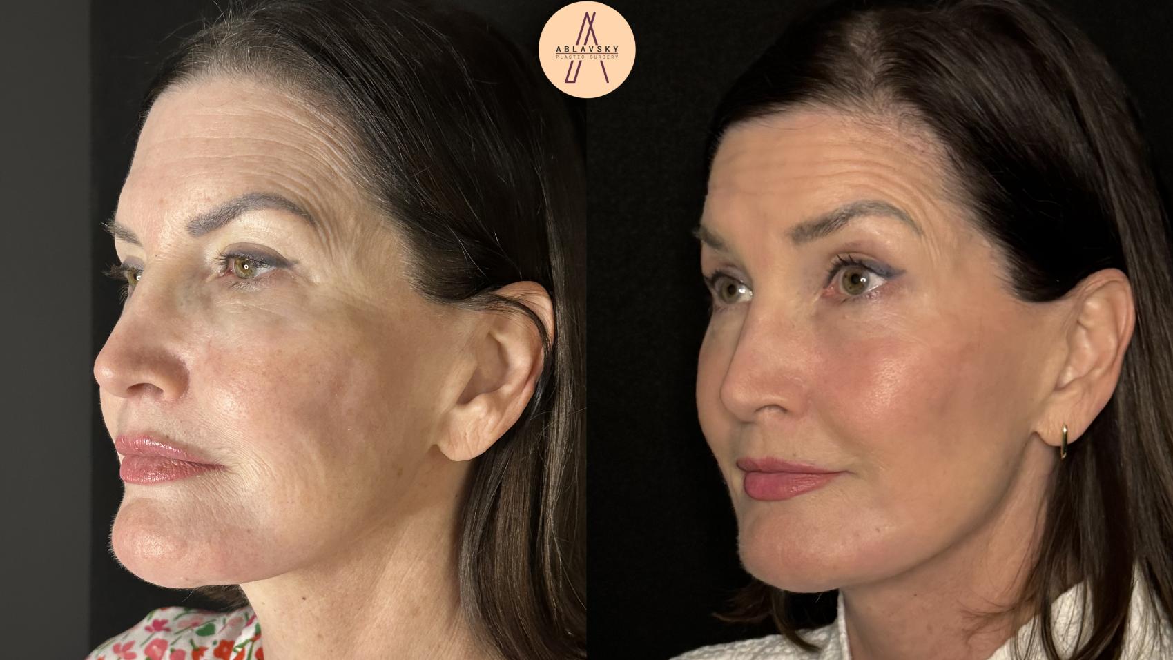 Before & After ECO2 Case 502 Left Oblique View in San Antonio, Texas
