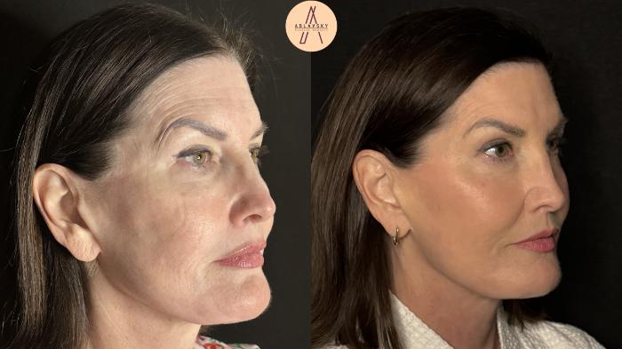 Before & After ECO2 Case 502 Right Oblique View in San Antonio, Texas
