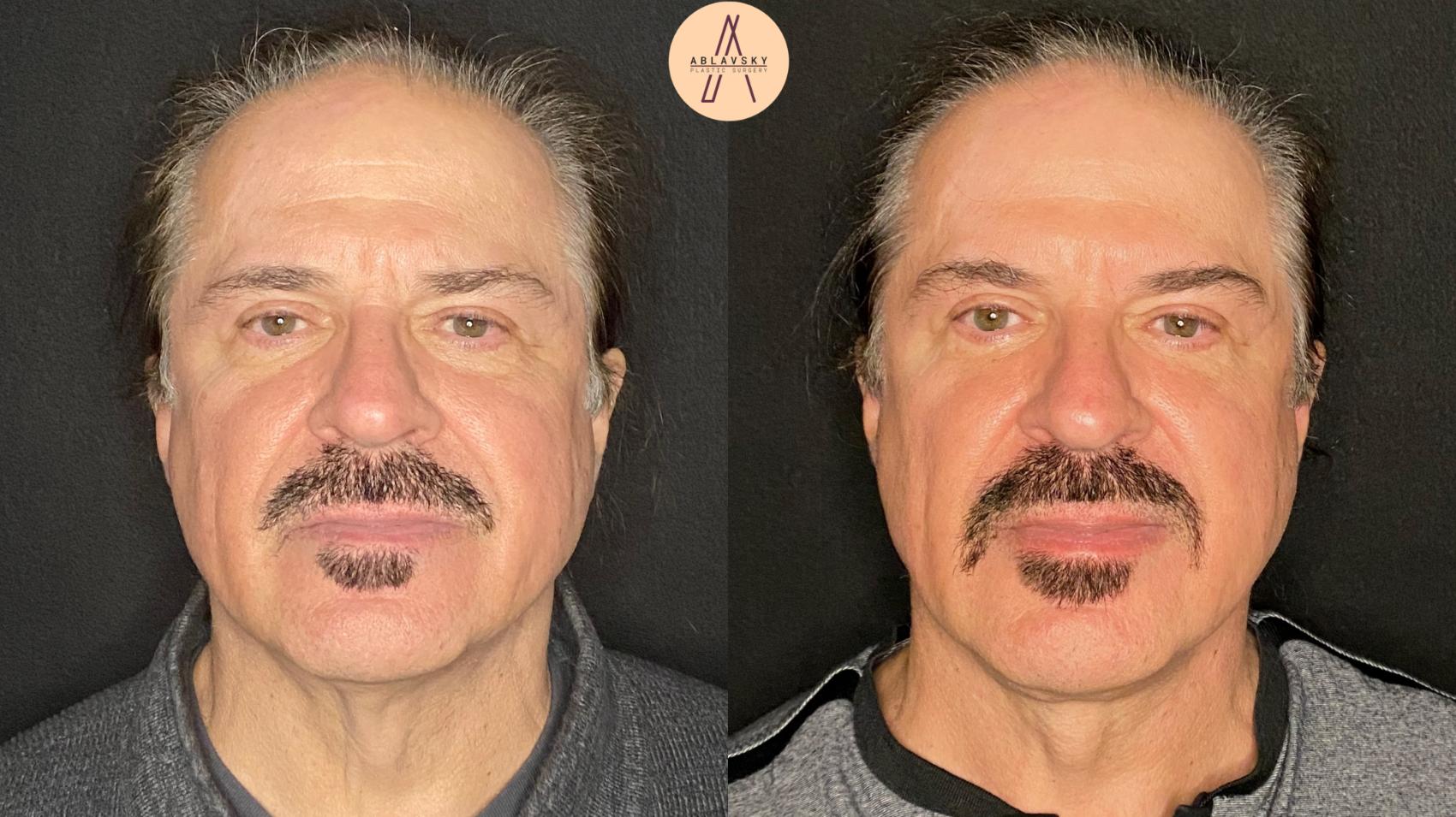 Before & After Facelift & Neck Lift Case 104 Front View in San Antonio, Texas