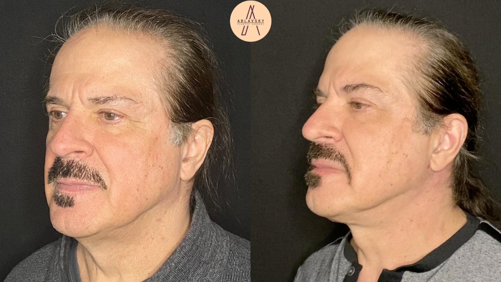 Before & After Facelift & Neck Lift Case 104 Left Oblique View in San Antonio, Texas