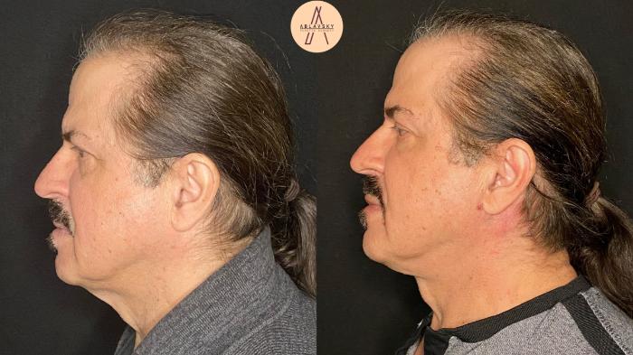 Before & After Facelift & Neck Lift Case 104 Left Side View in San Antonio, Texas