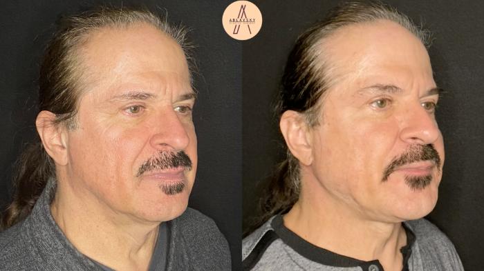 Before & After Facelift & Neck Lift Case 104 Right Oblique View in San Antonio, Texas