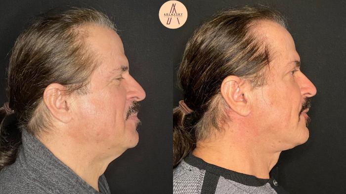 Before & After Facelift & Neck Lift Case 104 Right Side View in San Antonio, Texas