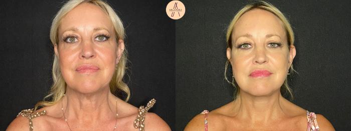 Before & After Facelift & Neck Lift Case 129 Front View in San Antonio, Texas