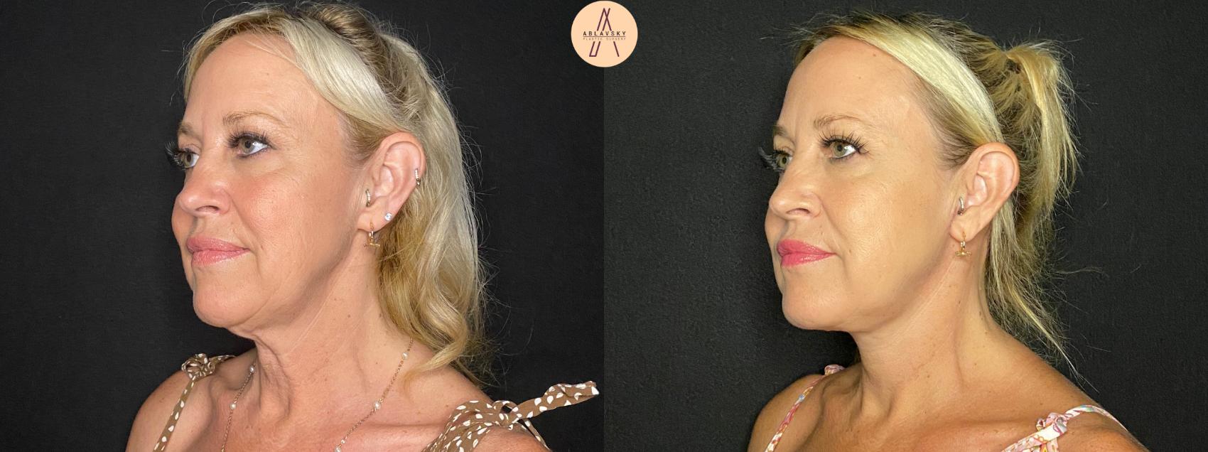 Before & After Facelift & Neck Lift Case 129 Left Oblique View in San Antonio, Texas