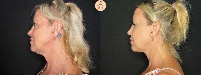 Before & After Facelift & Neck Lift Case 129 Left Side View in San Antonio, Texas