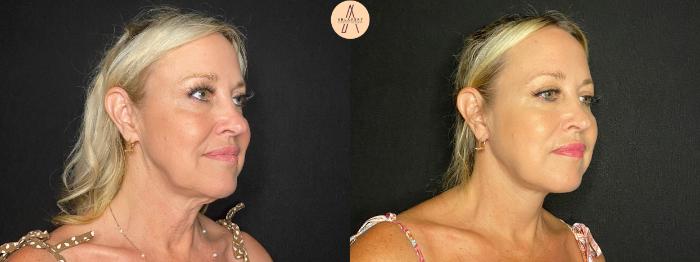 Before & After Facelift & Neck Lift Case 129 Right Oblique View in San Antonio, Texas