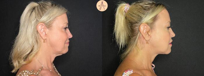 Before & After Facelift & Neck Lift Case 129 Right Side View in San Antonio, Texas