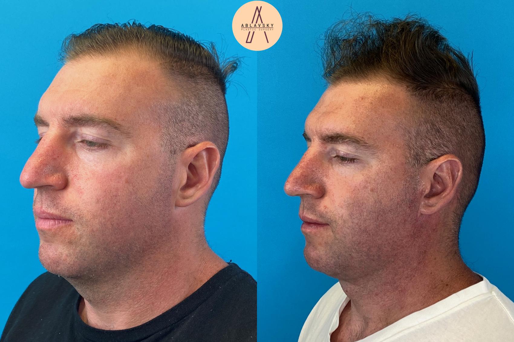 Before & After Facelift & Neck Lift Case 26 Left Oblique View in San Antonio, Texas