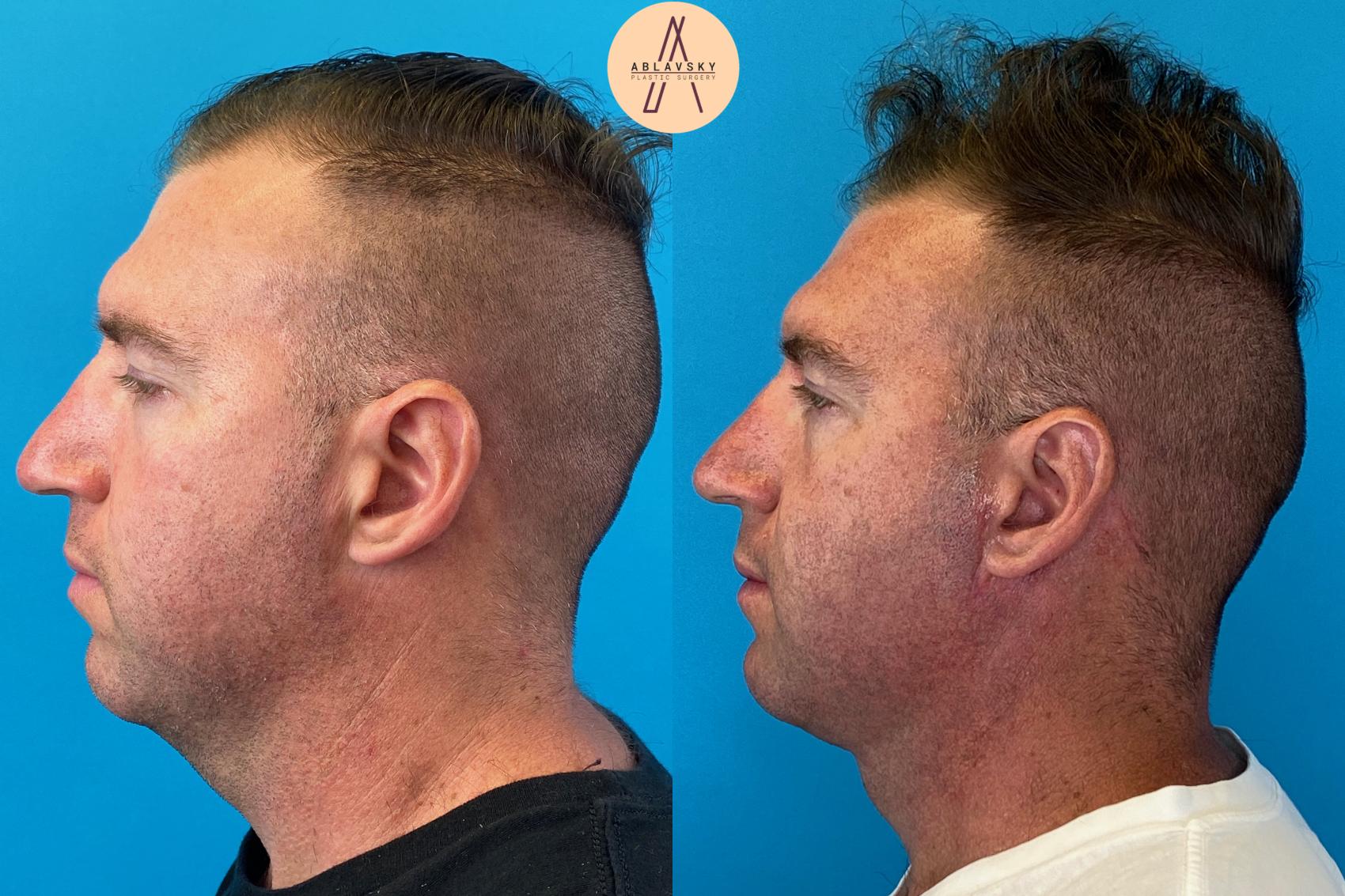Before & After Facelift & Neck Lift Case 26 Left Side View in San Antonio, Texas
