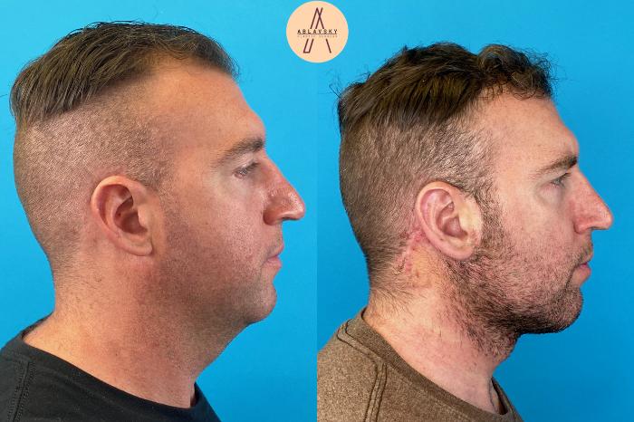 Before & After Facelift & Neck Lift Case 26 Right Side View in San Antonio, Texas