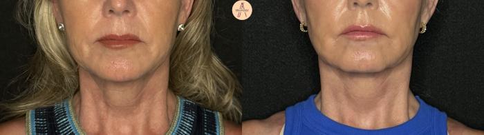 Before & After Facelift & Neck Lift Case 263 Front View in San Antonio, Texas