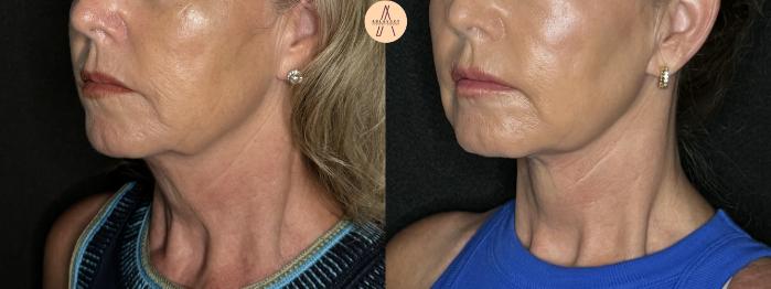 Before & After Facelift & Neck Lift Case 263 Left Oblique View in San Antonio, Texas