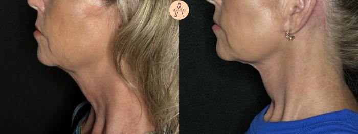 Before & After Facelift & Neck Lift Case 263 Left Side View in San Antonio, Texas