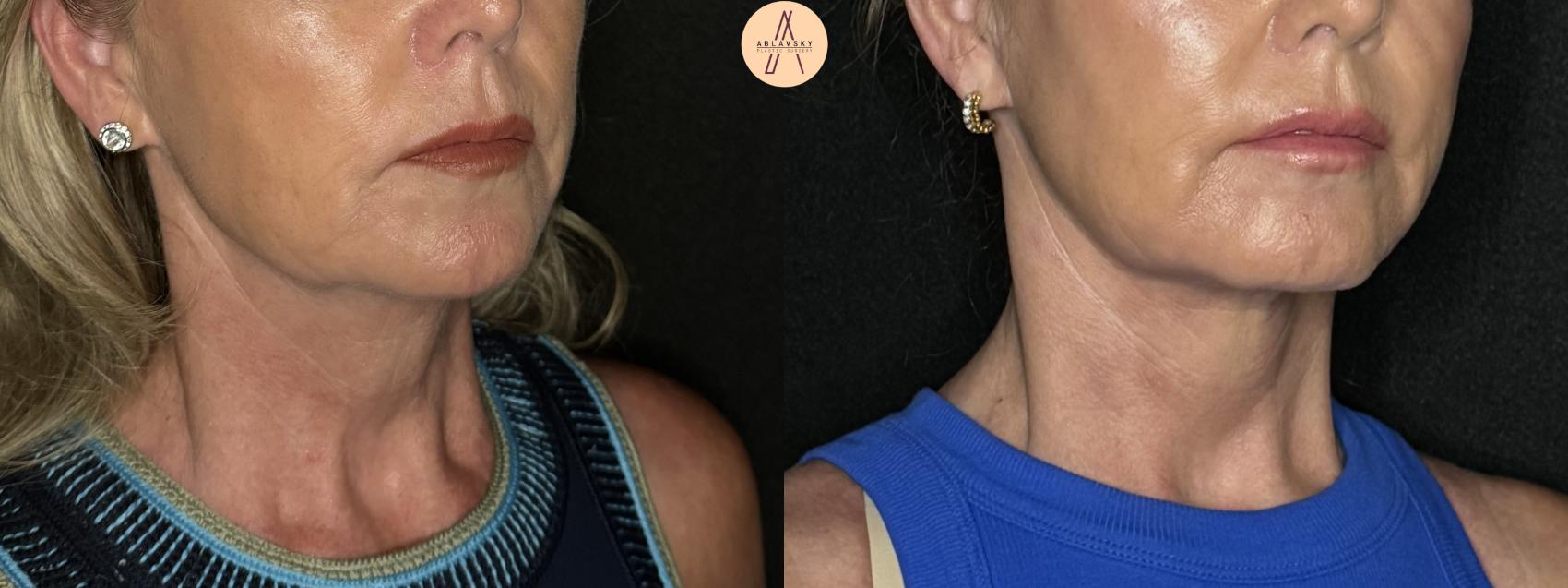 Before & After Facelift & Neck Lift Case 263 Right Oblique View in San Antonio, Texas