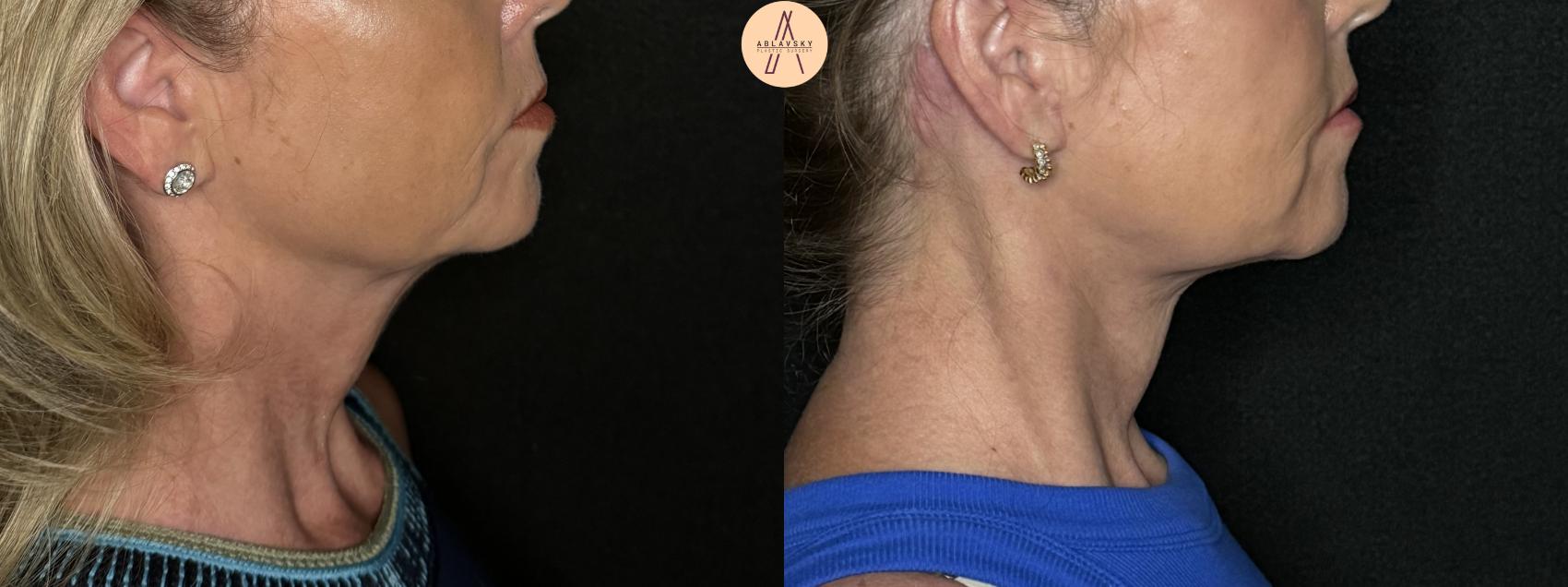 Before & After Facelift & Neck Lift Case 263 Right Side View in San Antonio, Texas