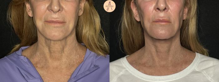 Before & After Facelift & Neck Lift Case 279 Front View in San Antonio, Texas