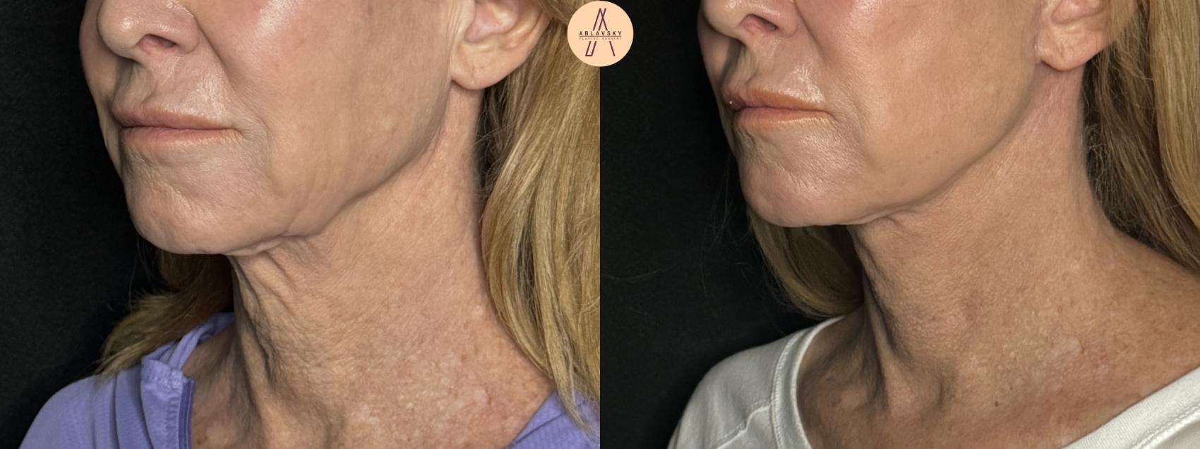 Before & After Facelift & Neck Lift Case 279 Left Oblique View in San Antonio, Texas