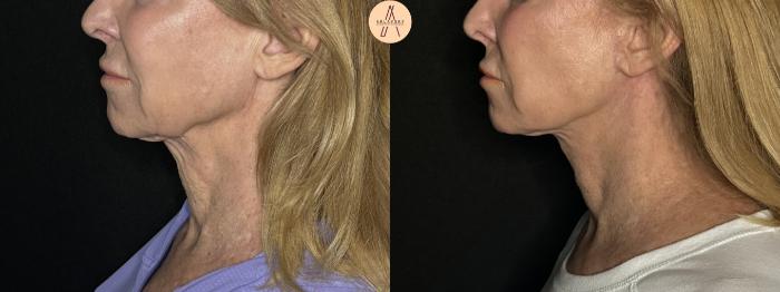 Before & After Facelift & Neck Lift Case 279 Left Side View in San Antonio, Texas