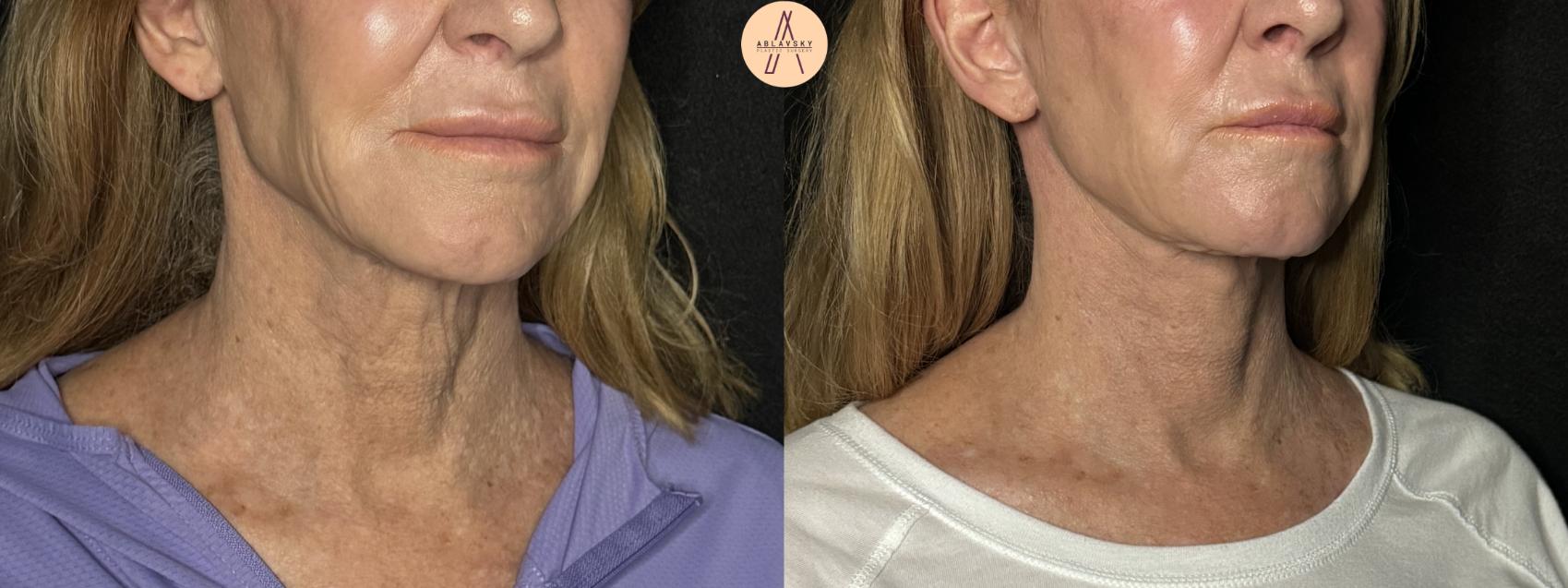 Before & After Facelift & Neck Lift Case 279 Right Oblique View in San Antonio, Texas
