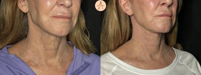 Before & After Facelift & Neck Lift Case 279 Right Oblique View in San Antonio, Texas