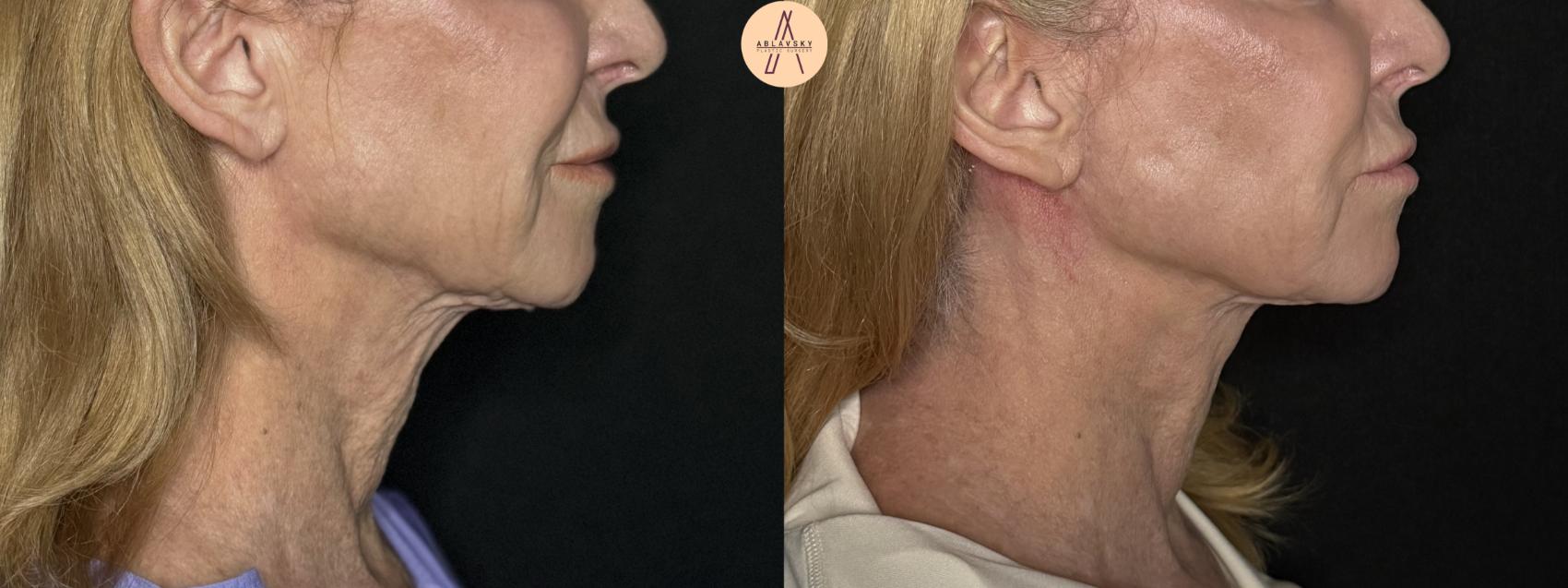 Before & After Facelift & Neck Lift Case 279 Right Side View in San Antonio, Texas