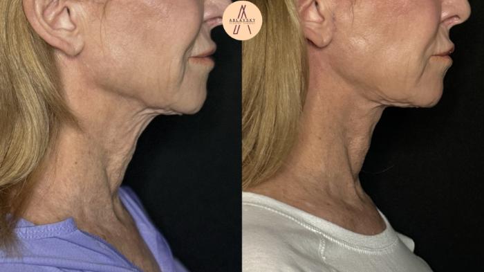 Before & After Facelift & Neck Lift Case 279 Right Side View in San Antonio, Texas