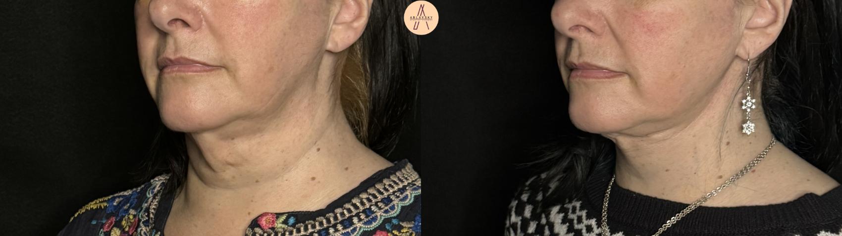 Before & After Facelift & Neck Lift Case 294 Left Oblique View in San Antonio, Texas