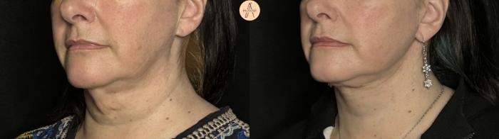 Before & After Facelift & Neck Lift Case 294 Left Oblique View in San Antonio, Texas