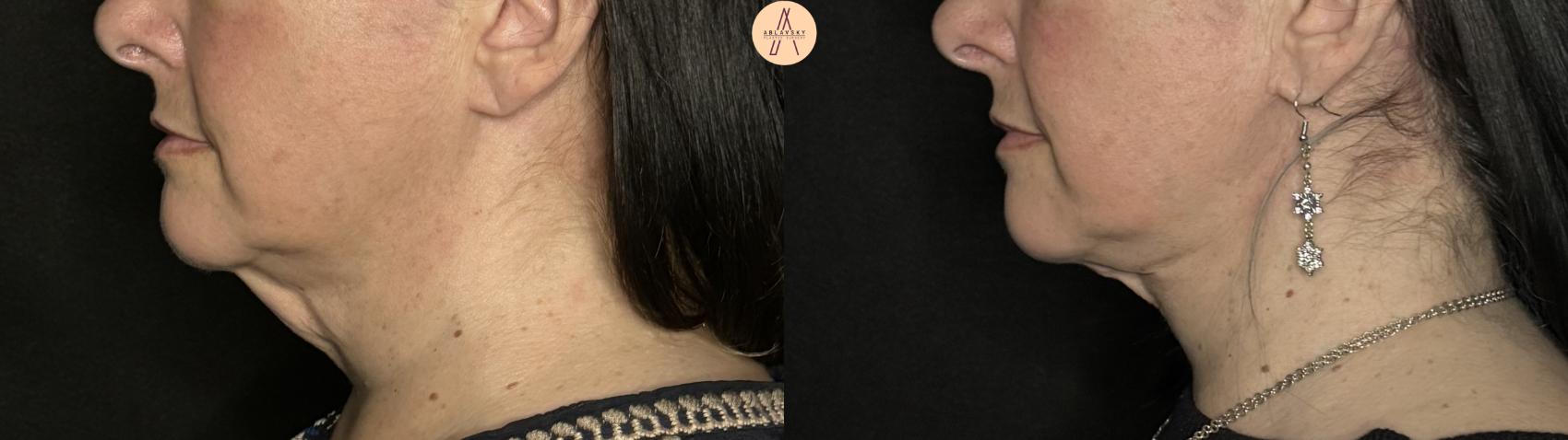 Before & After Facelift & Neck Lift Case 294 Left Side View in San Antonio, Texas