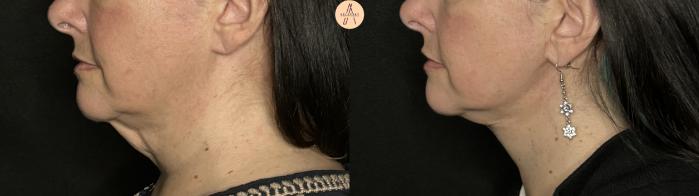 Before & After Facelift & Neck Lift Case 294 Left Side View in San Antonio, Texas