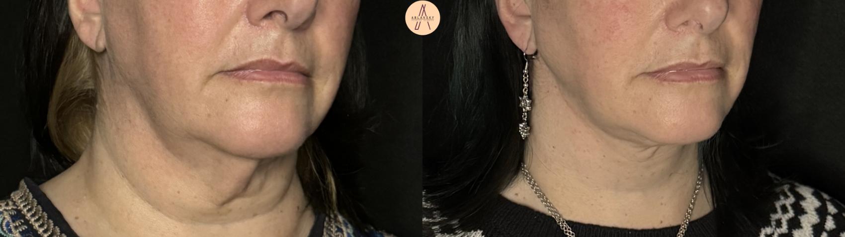 Before & After Facelift & Neck Lift Case 294 Right Oblique View in San Antonio, Texas